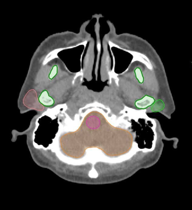 H＆N-CT_OAR_2
